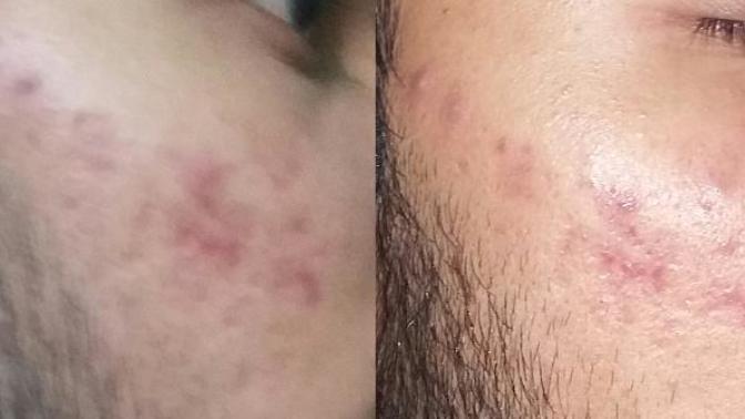 How to remove red spots from my face?