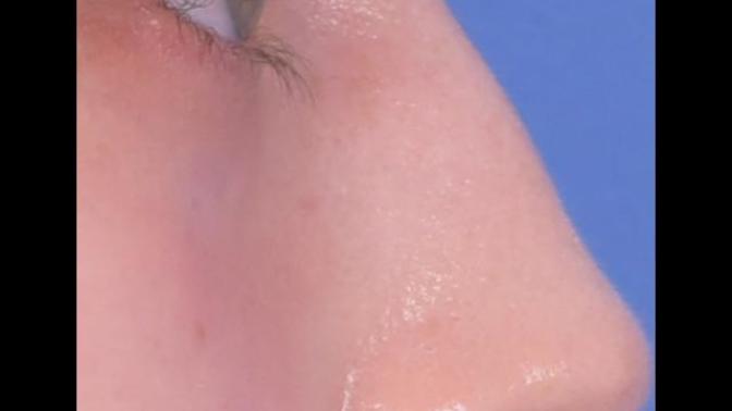 Be honest - do I have a bump on my nose?