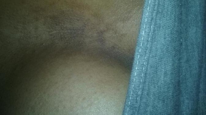 I'm only 14 & I've been noticing whenever I take my bra off, it will be these darks spots in between my breasts🙄🙄 what is it?