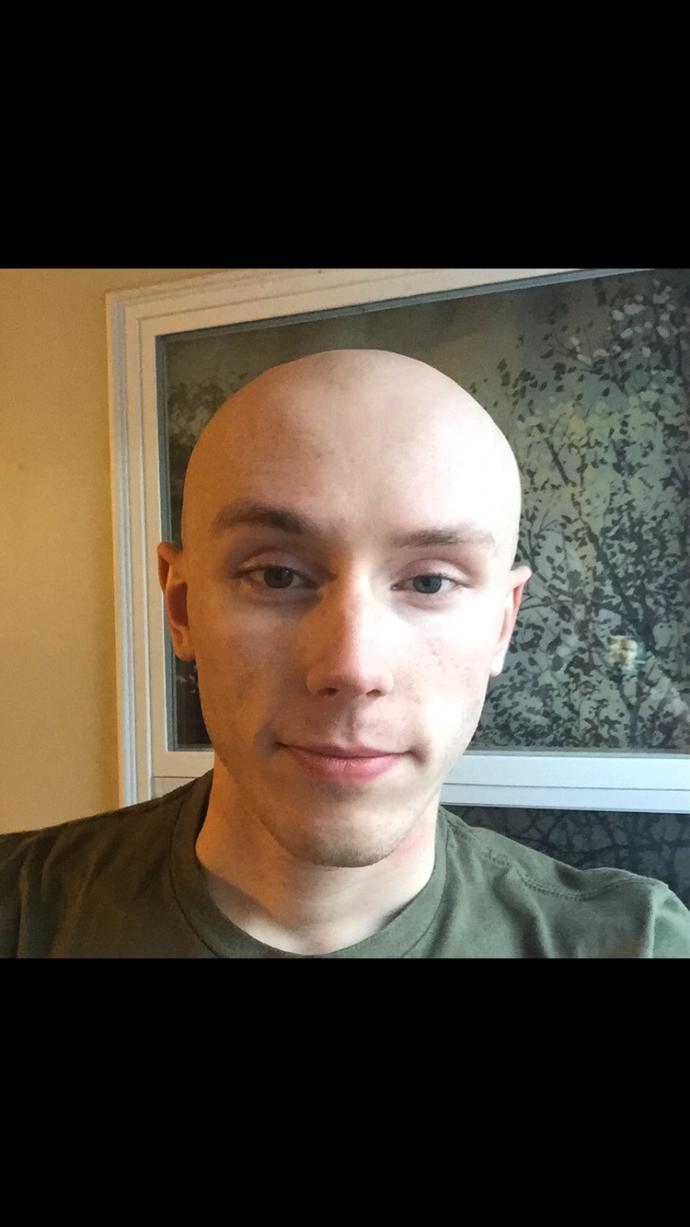 Girls, could you date a guy with this condition or is it a no-go for you (based only on looks here)?