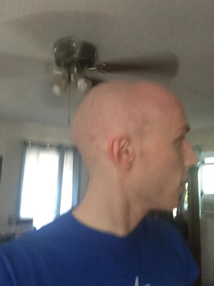Girls, 18-24 Do I pull off shaved? It's my only real option now so be honest? Or is hair important to you?