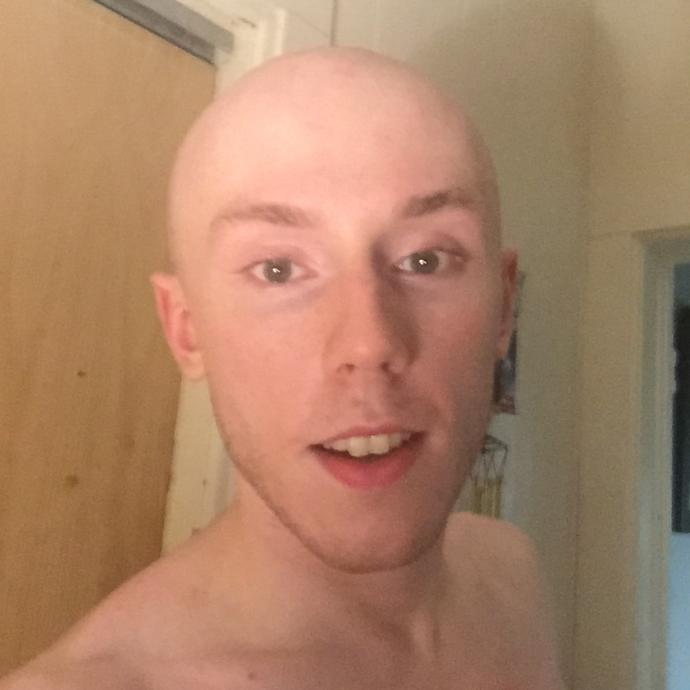 Girls, 18-24 Do I pull off shaved? It's my only real option now so be honest? Or is hair important to you?
