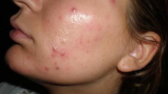 Do you notice mild acne? Does it gross you out? or does only severe acne disgust you?