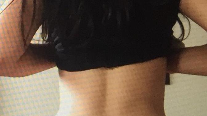 Are moles (beauty marks) ugly?