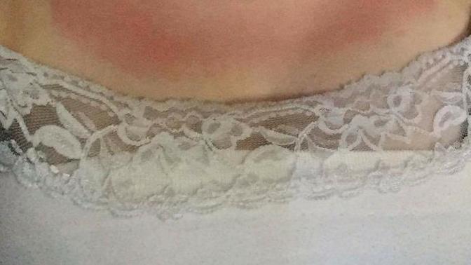 How can I remove this sunburn? Will my skin darken?