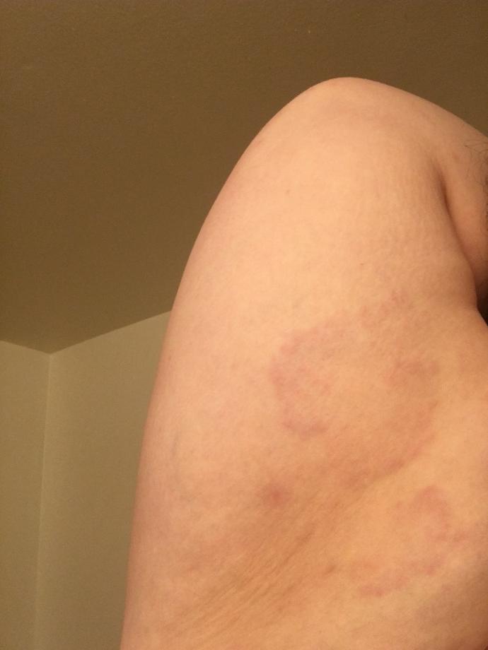What is this on my friends arm?