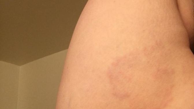 What is this on my friends arm?