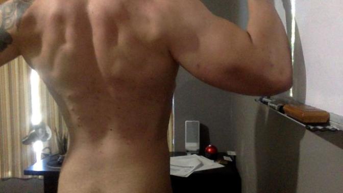 Can you guess how many pimples I have on my back due to roid acne?