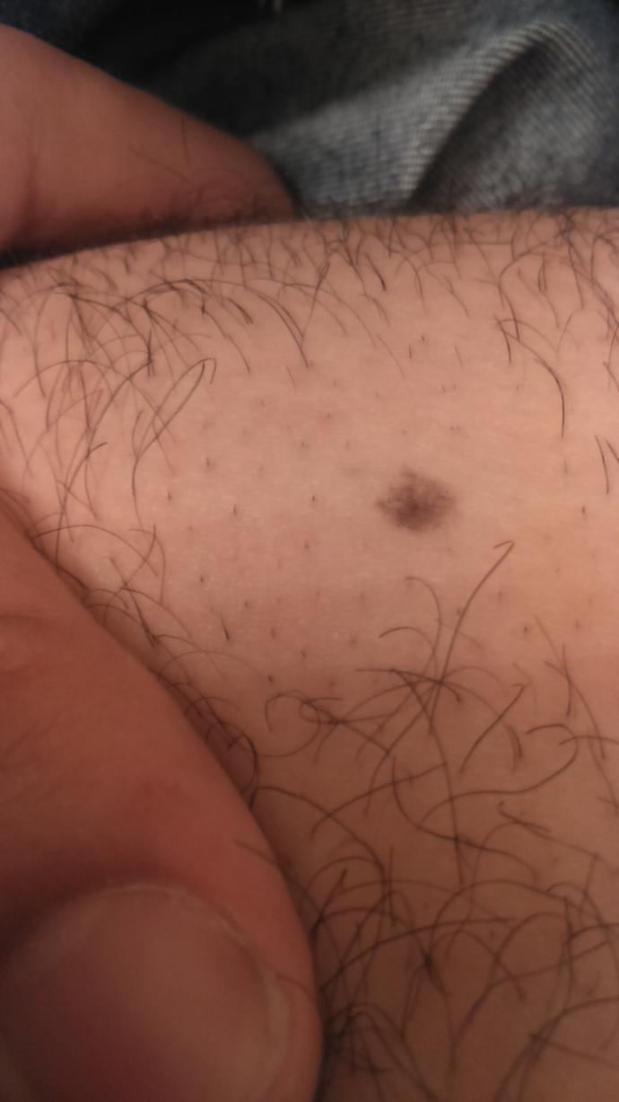 Do i have skin cancer?