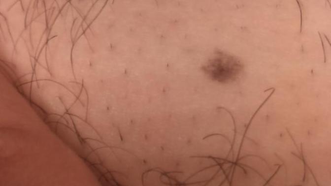 Do I have skin cancer?