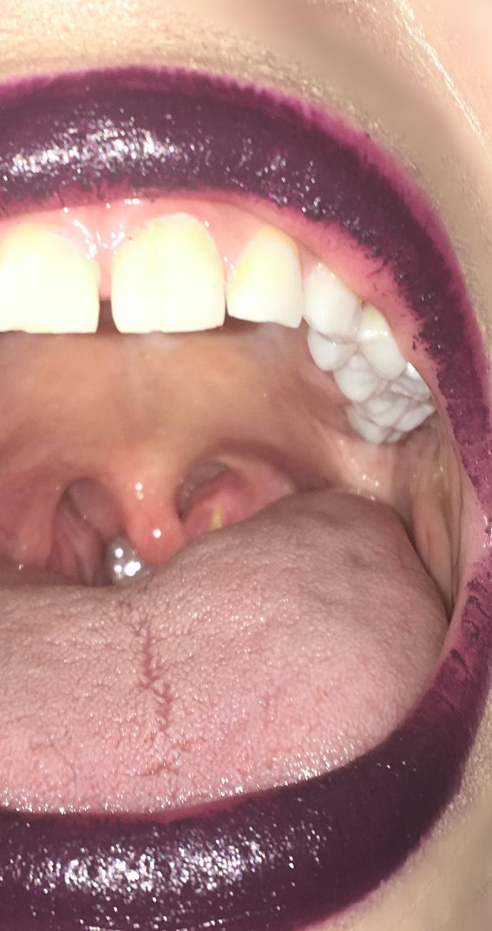 What is this in my mouth?