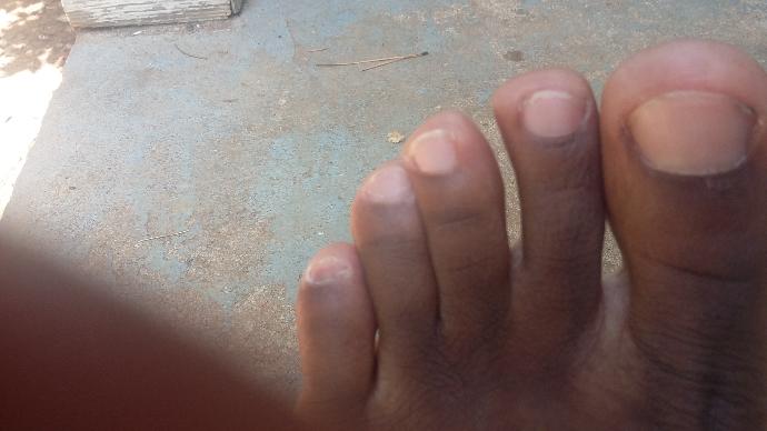 My pinky toes look bad like dark what's wrong?