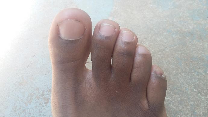 My pinky toes look bad like dark what's wrong?