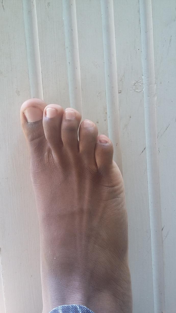 My pinky toes look bad like dark what's wrong?