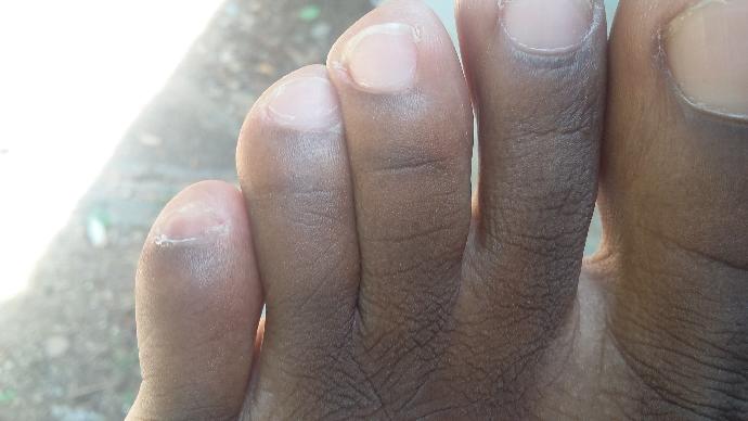 My pinky toes look bad like dark what's wrong?