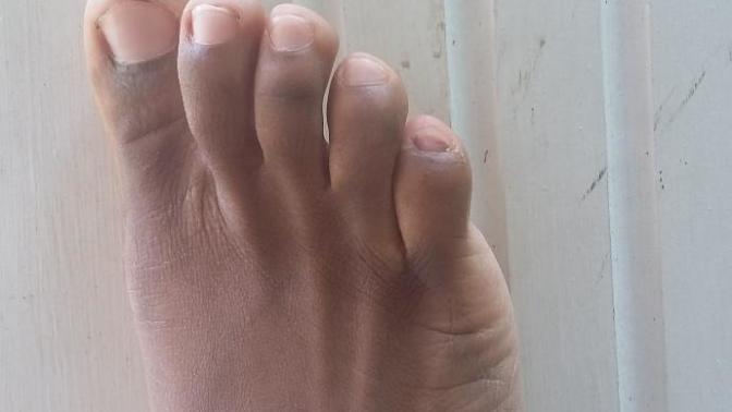 My pinky toes look bad like dark what's wrong?