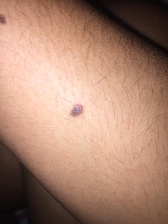 Does this mole look werid ?