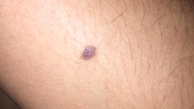 Does this mole look werid?