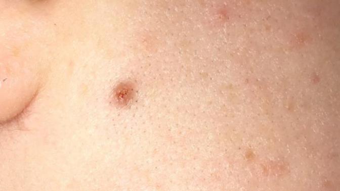 DO I HAVE AN INGROWN HAIR?