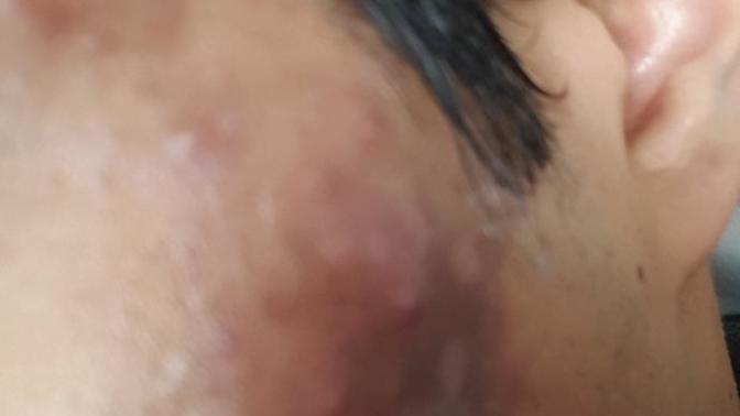 Acne scars, how can I get rid of?
