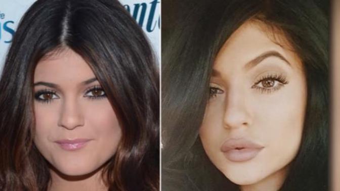 How would you feel if your girlfriend wants to get lip fillers? Girls and guys how do you feel about lip fillers?