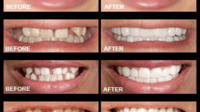 Would you date someone with a Snap-On Smile?