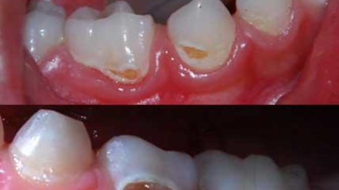 I discovered a rather large cavity on one of my teeth. Not sure how to proceed. Advice?