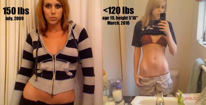 What are signs you're developing anorexia?