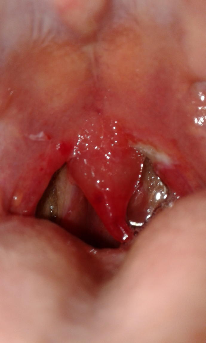 Any advice on tonsillectomy healing?