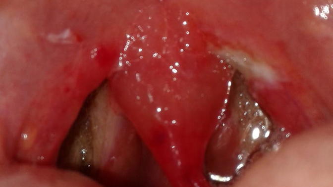 Any advice on tonsillectomy healing?