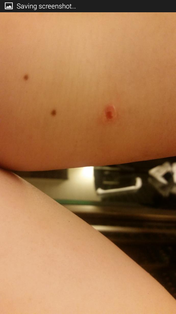 What kind of bite/ouchie is this?