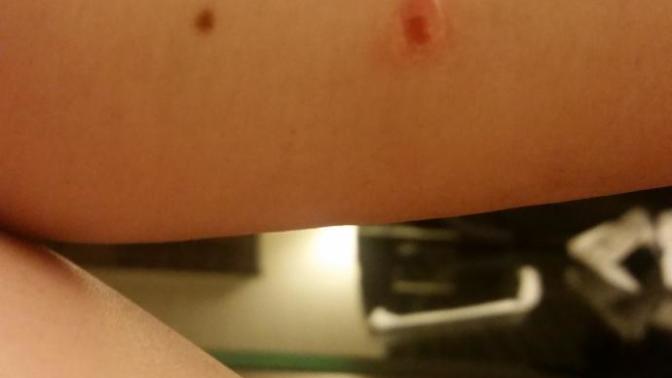 What kind of bite/ouchie is this?