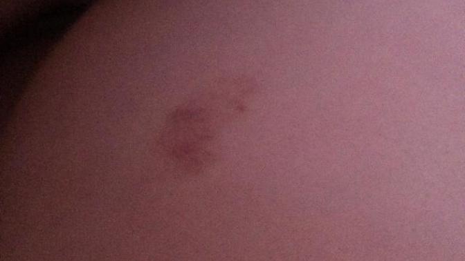 Weird bruise on my pregnant belly?