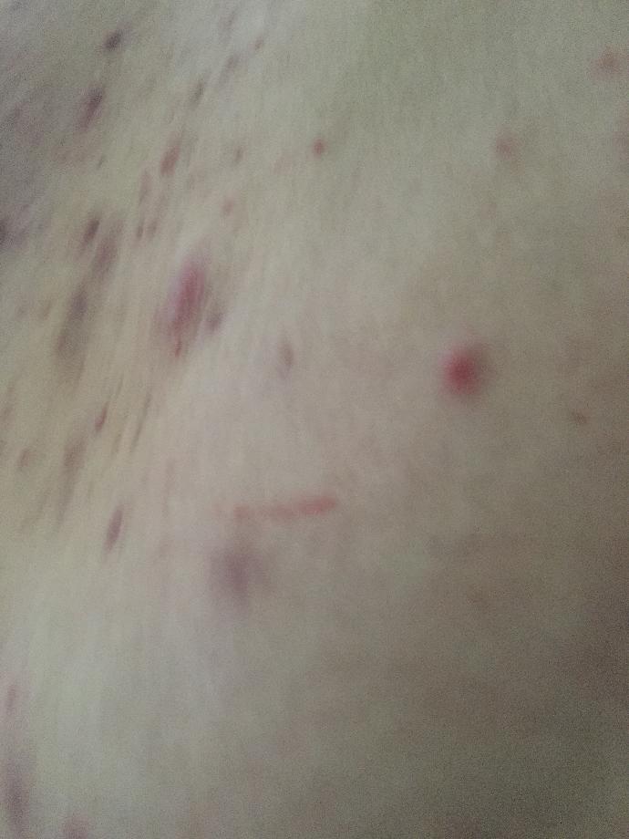 What are these bumps under my breasts?