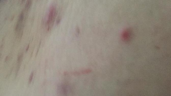 What are these bumps under my breasts?