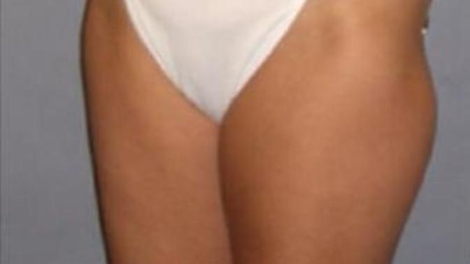 Any exercise that will fix this gap?