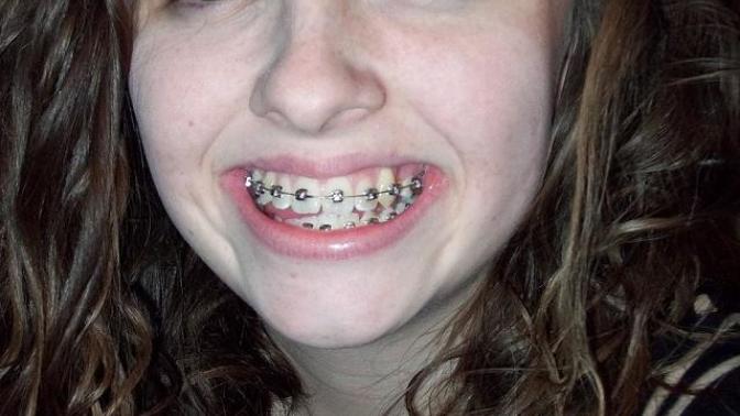 Girls, had my braces put on today, do they look bad?