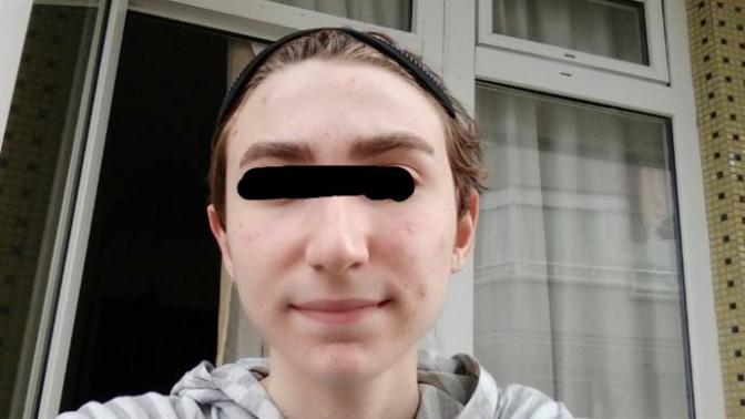 Do my acnes look very much?