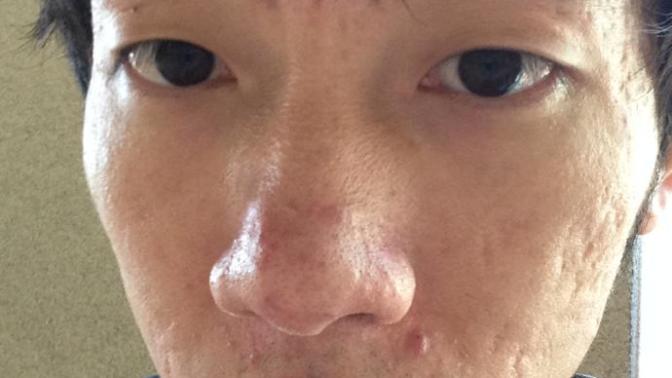 Girls do you still consider me a romantic partner despite my acne/acne scars? Or do I need to kill myself? Im fugly enough and I know it. No pity plz?
