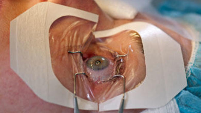Is lasik eye surgery worth it?