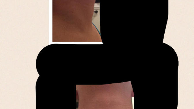What is this lump on my throat under my Adam's apple?