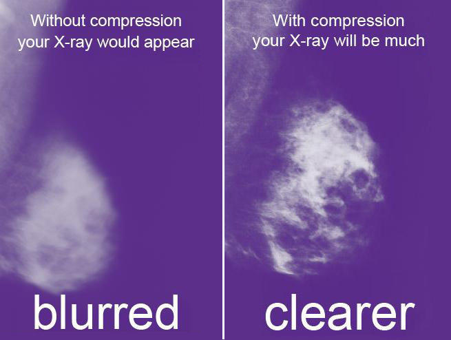 Girls, if when you get a mammogram, you don't feel any discomfort, would you tell your technologist to squeeze harder?