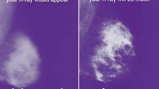Girls, if when you get a mammogram, you don't feel any discomfort, would you tell your technologist to squeeze harder?