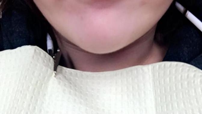 How long did you bleed after your wisdom teeth came out?