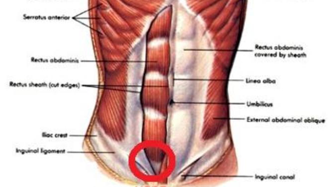 For anyone who is very physically active: telling between a hernia and an abdominal wall tear?