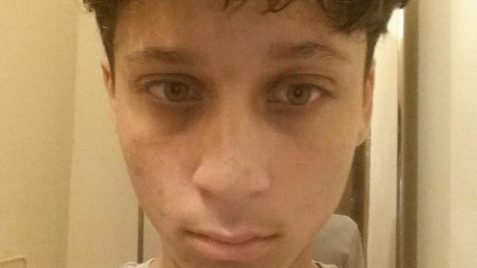 Are the dark circles underneath my eyes a turnoff to most girls?
