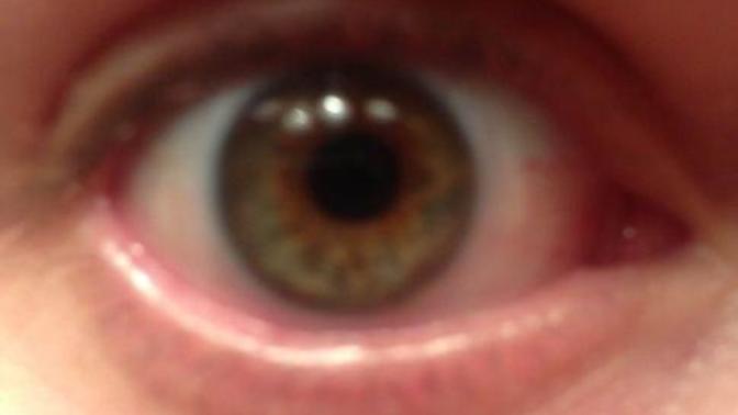 My eye is turning green? Should I worry?