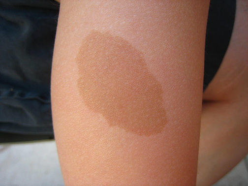 Guys, would you marry a girl with birthmark?