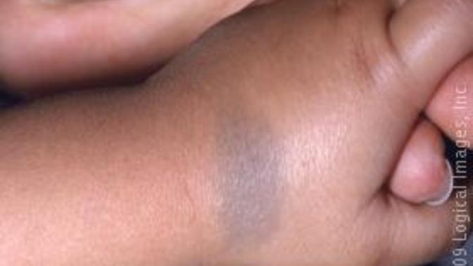 Guys, would you marry a girl with birthmark?