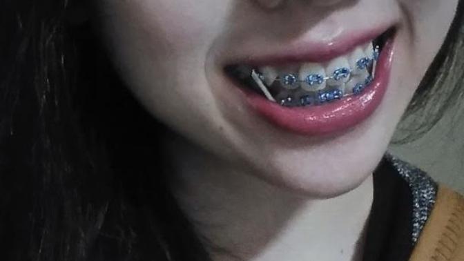 Okay: I'm self conscious about my new braces, do I look okay?